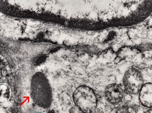 brain vessel - CADASIL - arrow:granular osmiophilic material (GOM)in basement membrane brain vessel - CADASIL - arrow:granular osmiophilic material (GOM)in basement membrane